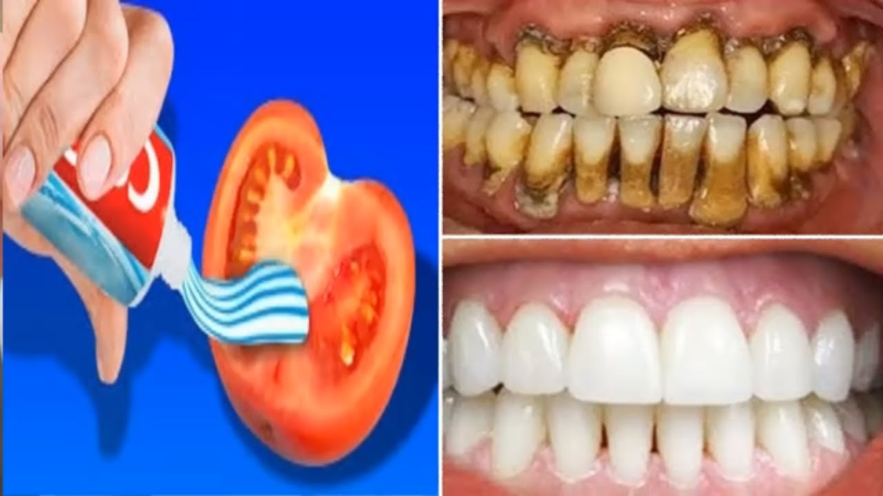 Phương pháp làm trắng răng kỳ diệu sau 2 phút răng xỉn màu ố vàng cũng trắng bóc-How to whiten teeth
